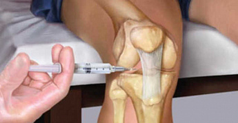 Гиалуроновая кислота для здоровья суставов. Новинки в ассортименте!