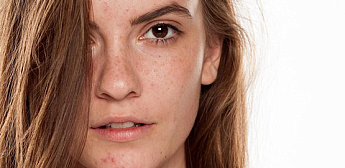 Уникальный подход к проблемной коже!